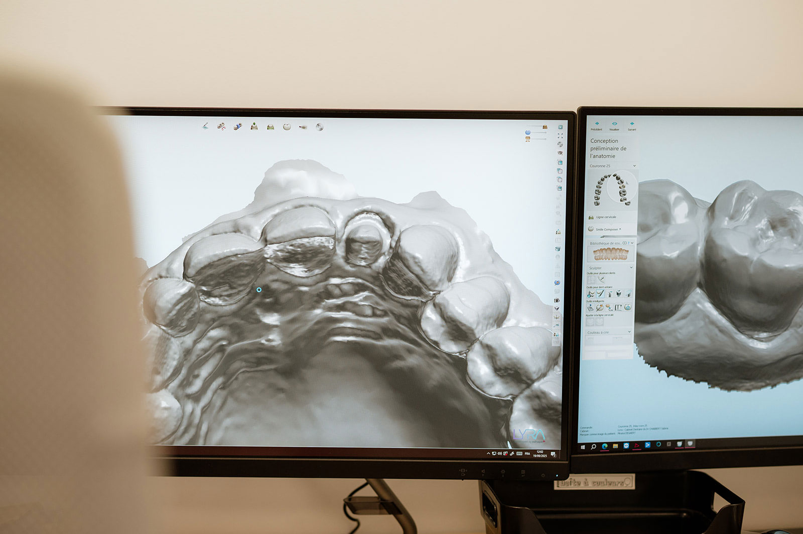 La CFAO dentaire : pilier de notre savoir-faire