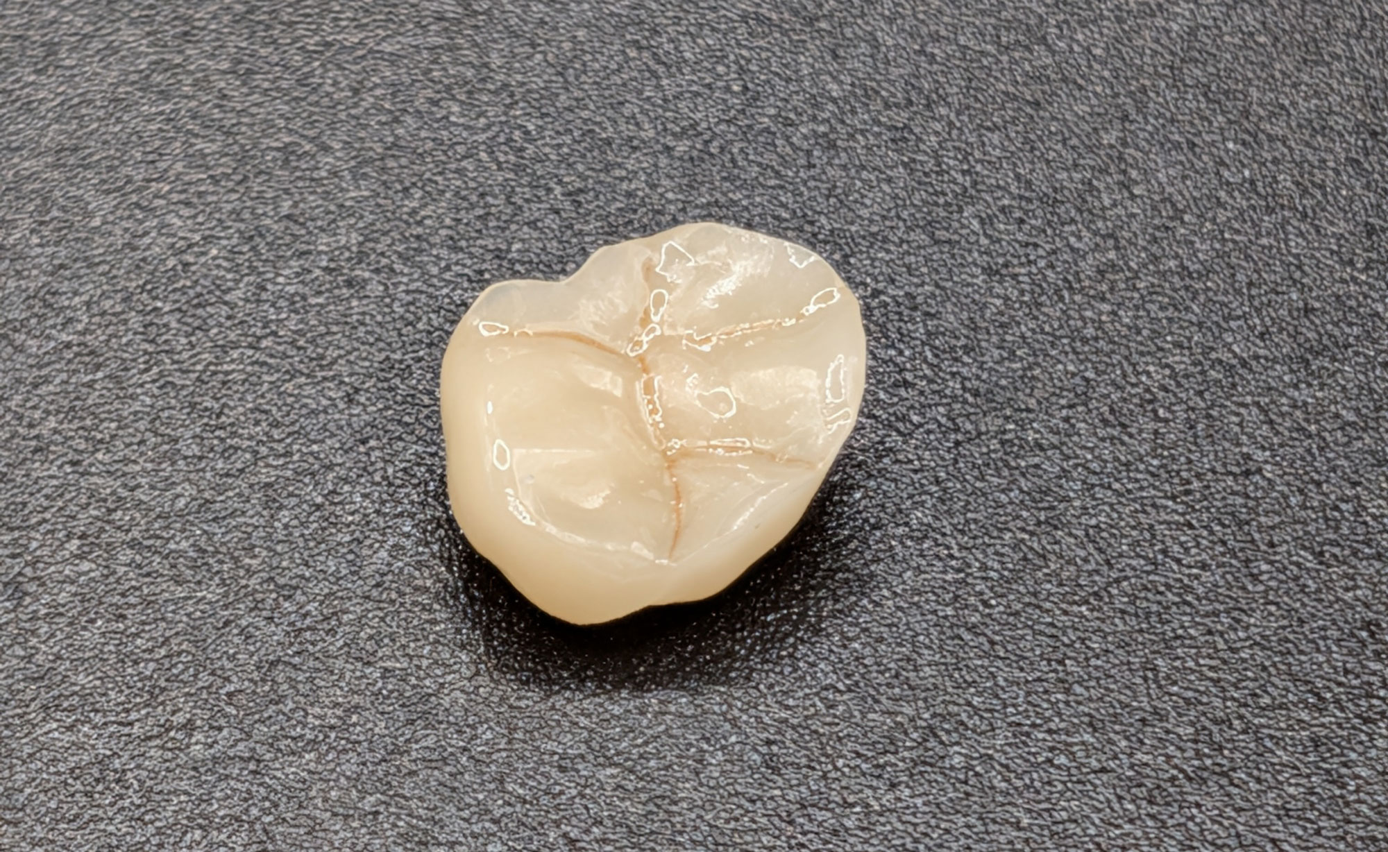 Couronne molaire esthétique réalisée en laboratoire dentaire