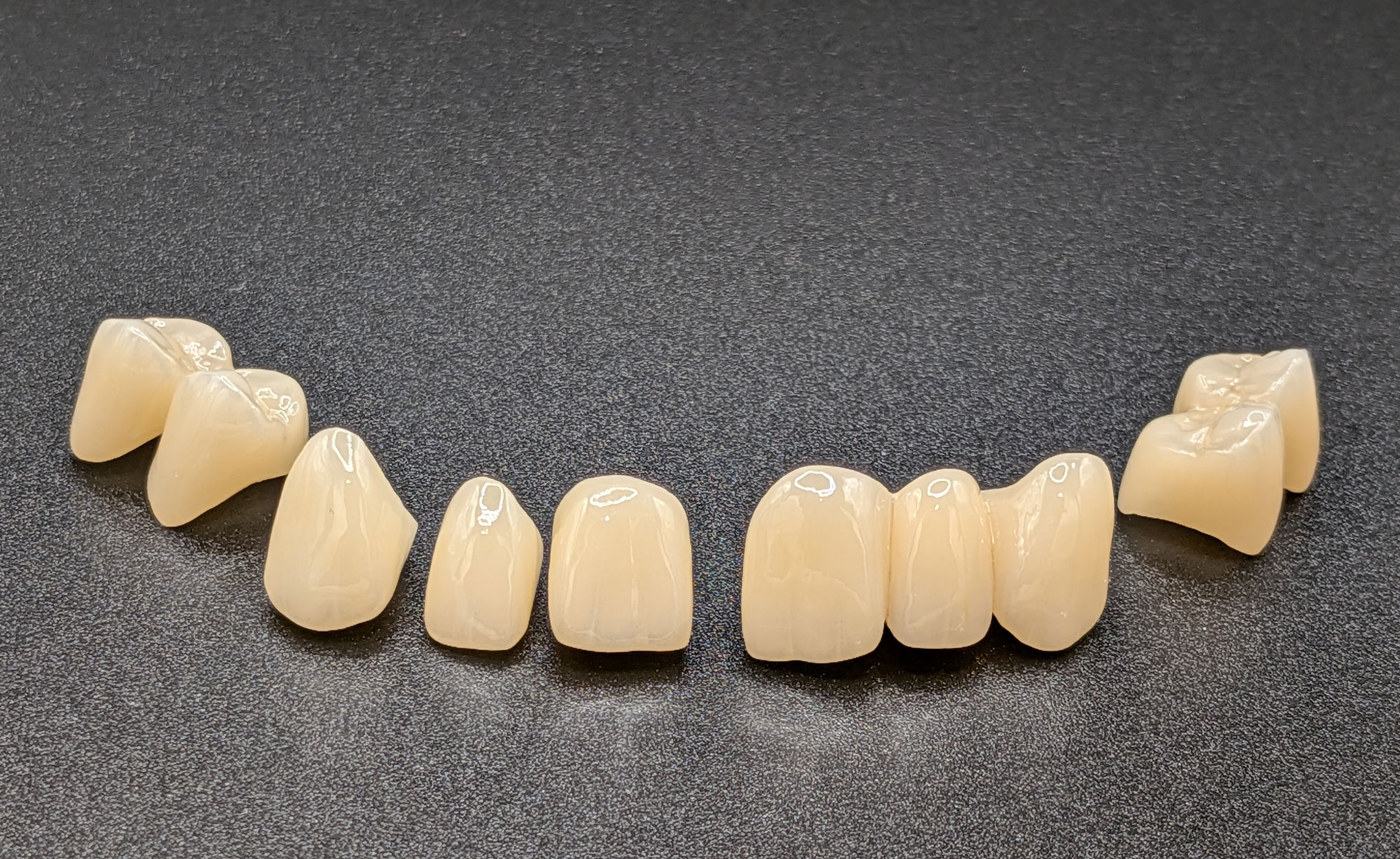 Facettes dentaires esthétiques réalisées sur mesure