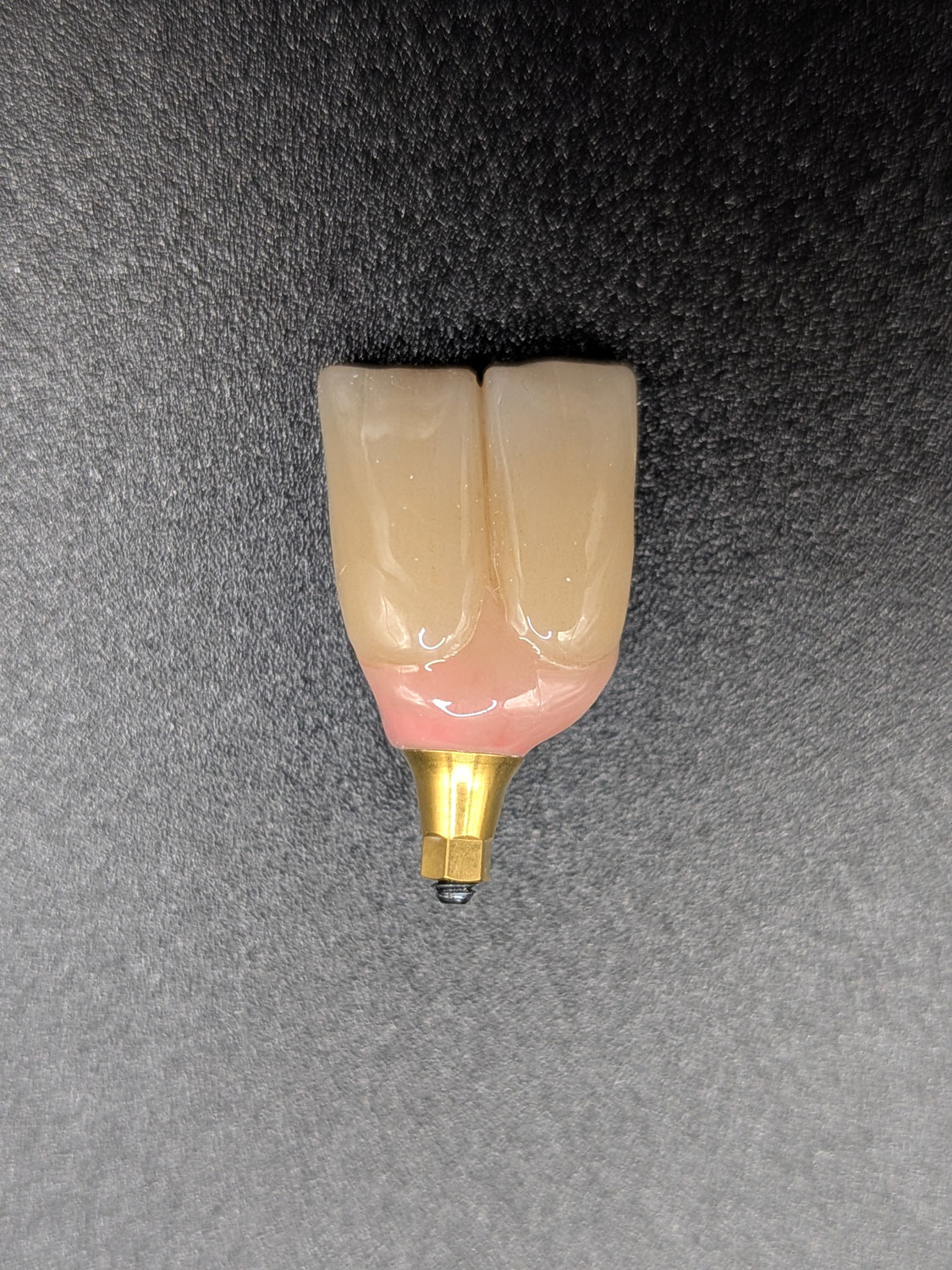 Couronne unitaire sur implant Dent unitaire implantaire en céramique