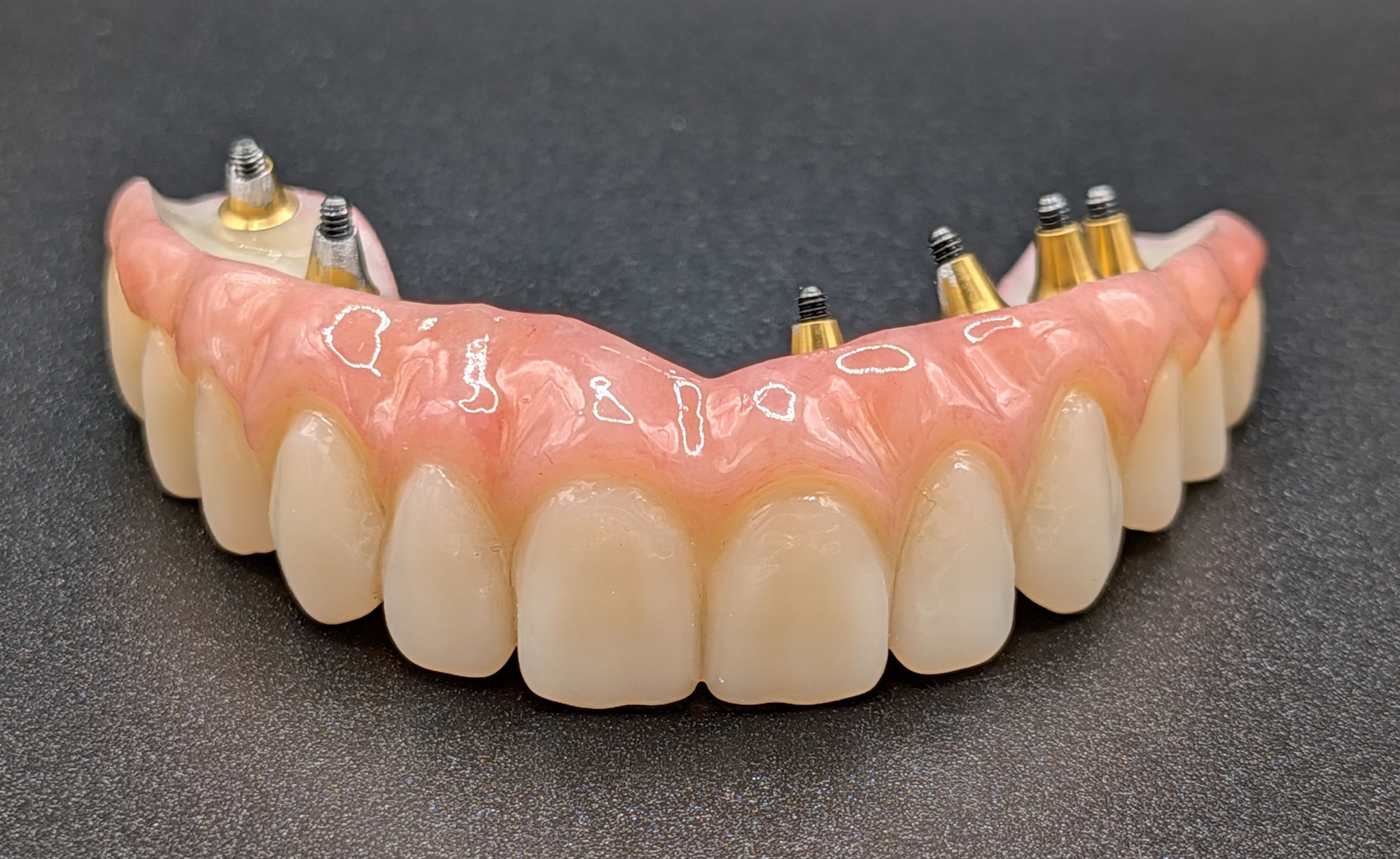 Prothèse complète sur implants réalisée en CFAO