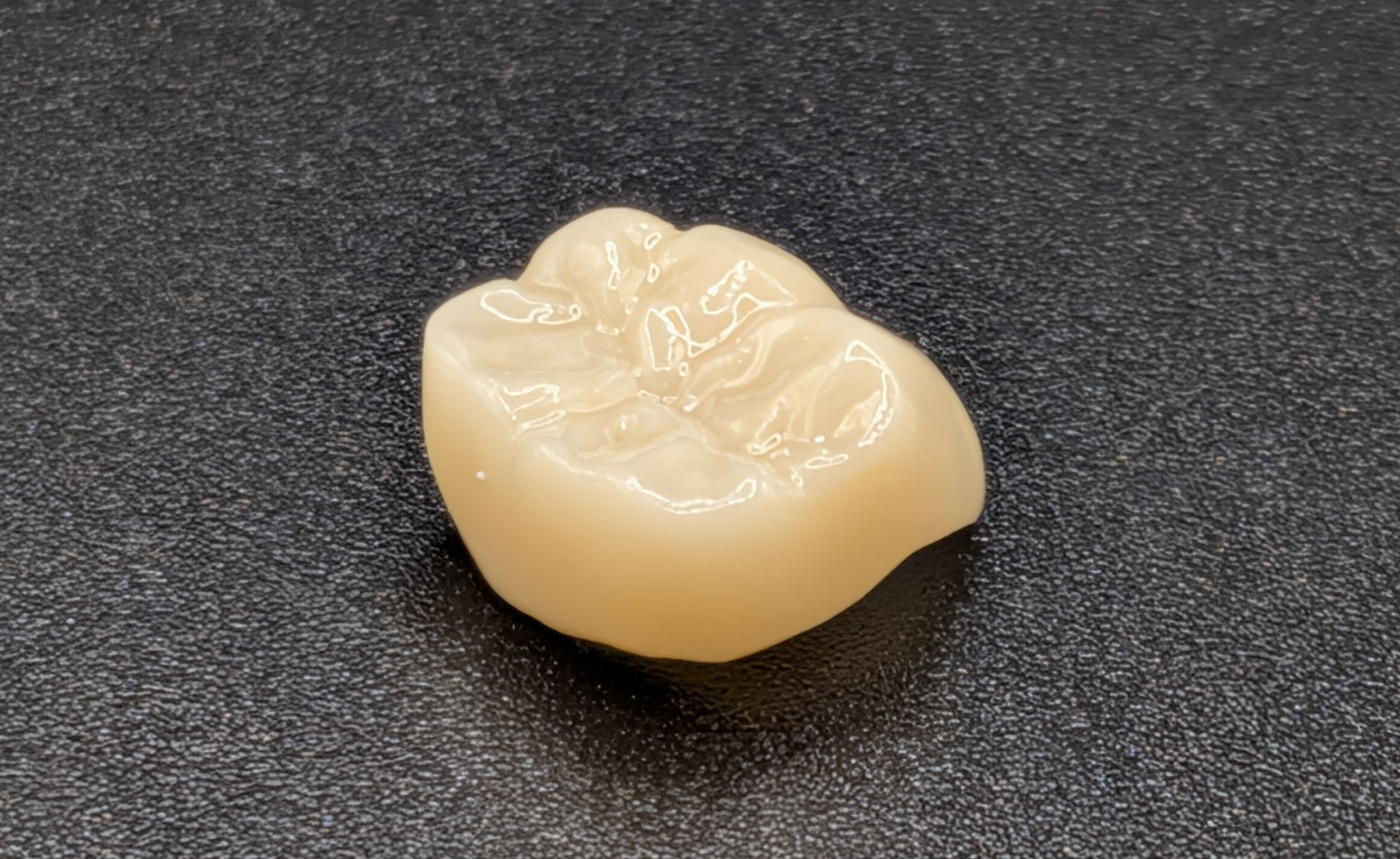 Couronne dentaire en zircone réalisée sur mesure