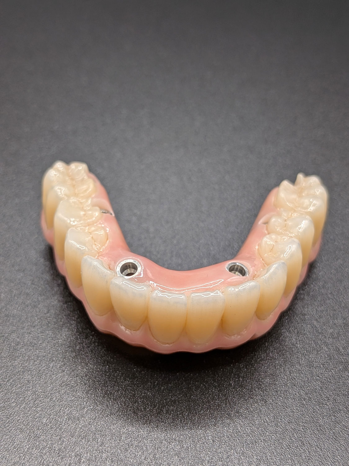Prothèse implantaire complète Prothèse complète sur implants dentaires