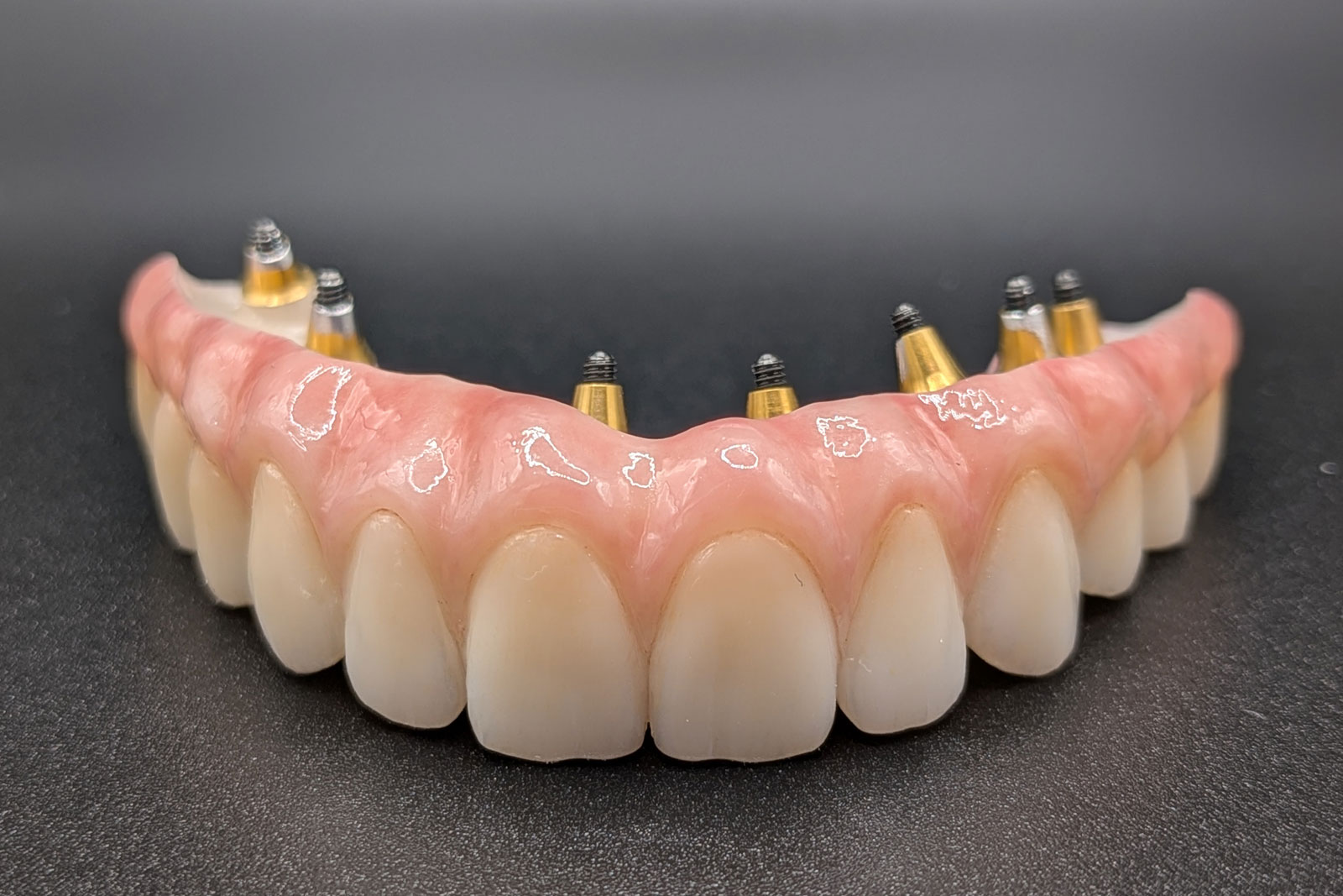 Prothèse complète sur implants réalisée en CFAO dentaire