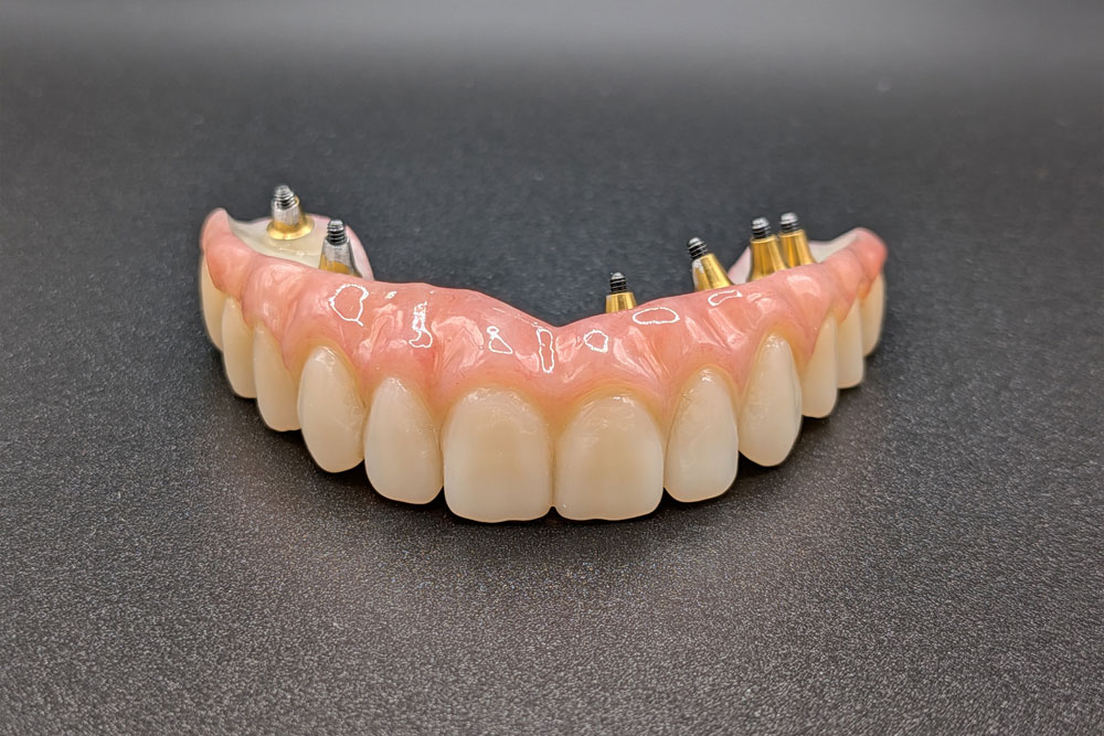 Prothèse dentaire complète maquillée sur implants