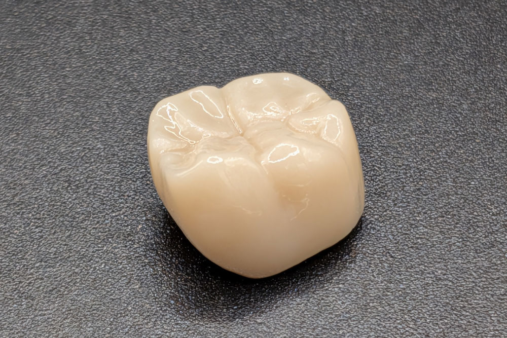 Bridge dentaire monochrome en zircone réalisé sur mesure