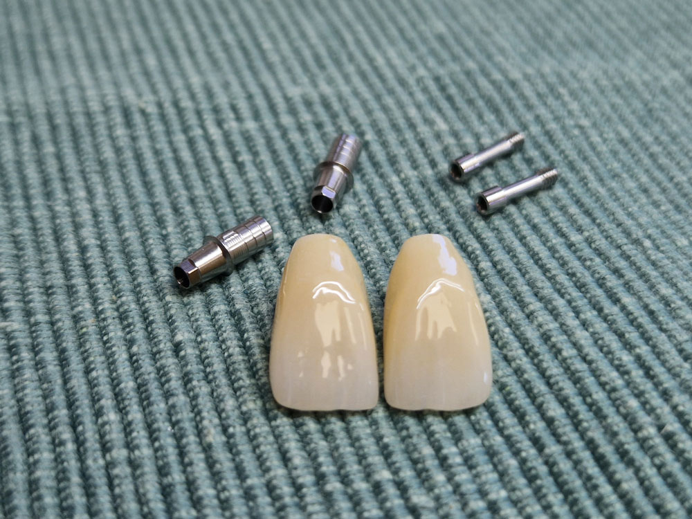 Couronnes dentaires implantaires Couronnes dentaires sur implants en zircone